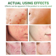🌿ClearSkin™ Acne Repair Serum Oil