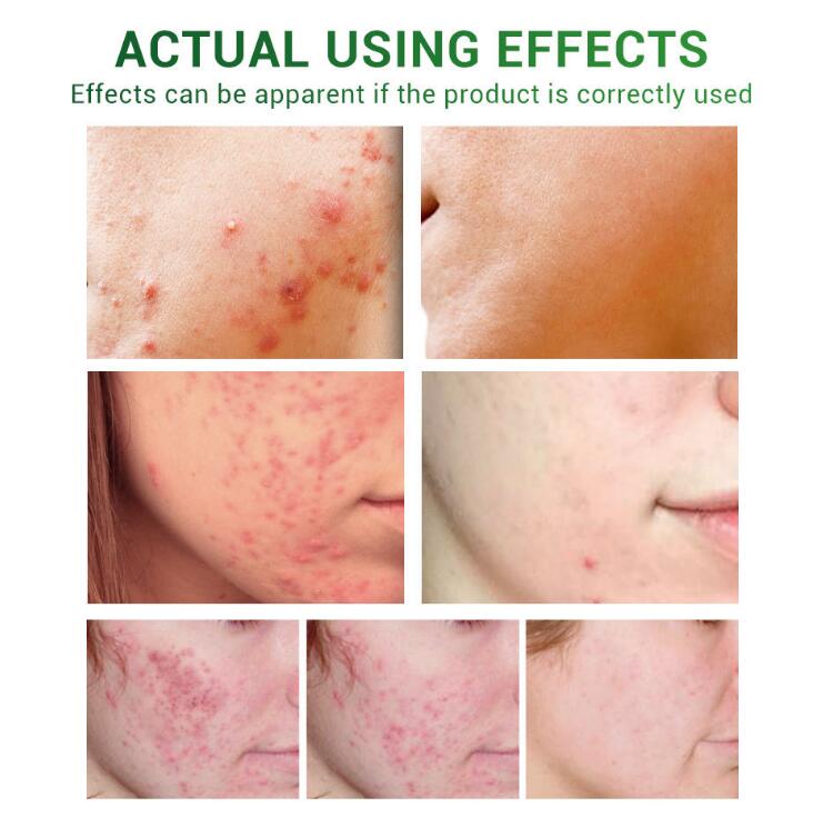 🌿ClearSkin™ Acne Repair Serum Oil