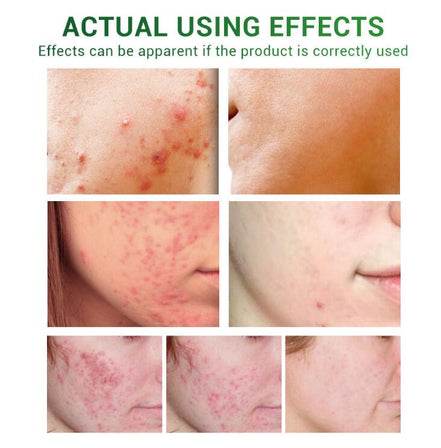 🌿ClearSkin™ Acne Repair Serum Oil
