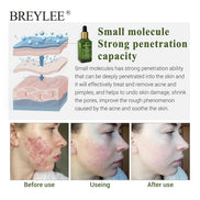 💧✨ BREYLEE Acne Treatment Serum