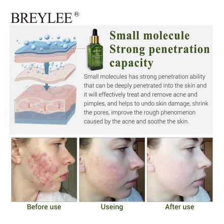 💧✨ BREYLEE Acne Treatment Serum