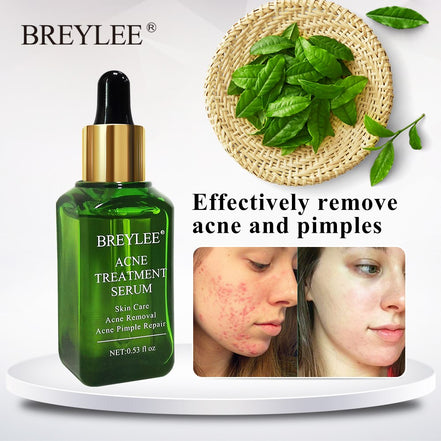 💧✨ BREYLEE Acne Treatment Serum