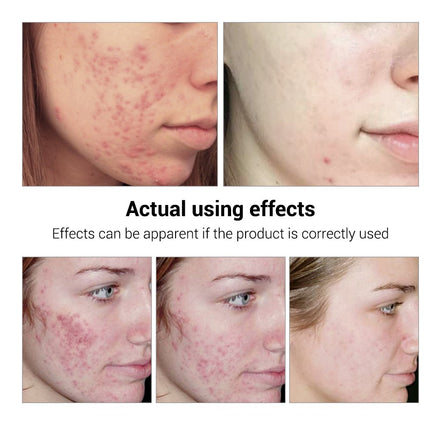 💧✨ BREYLEE Acne Treatment Serum