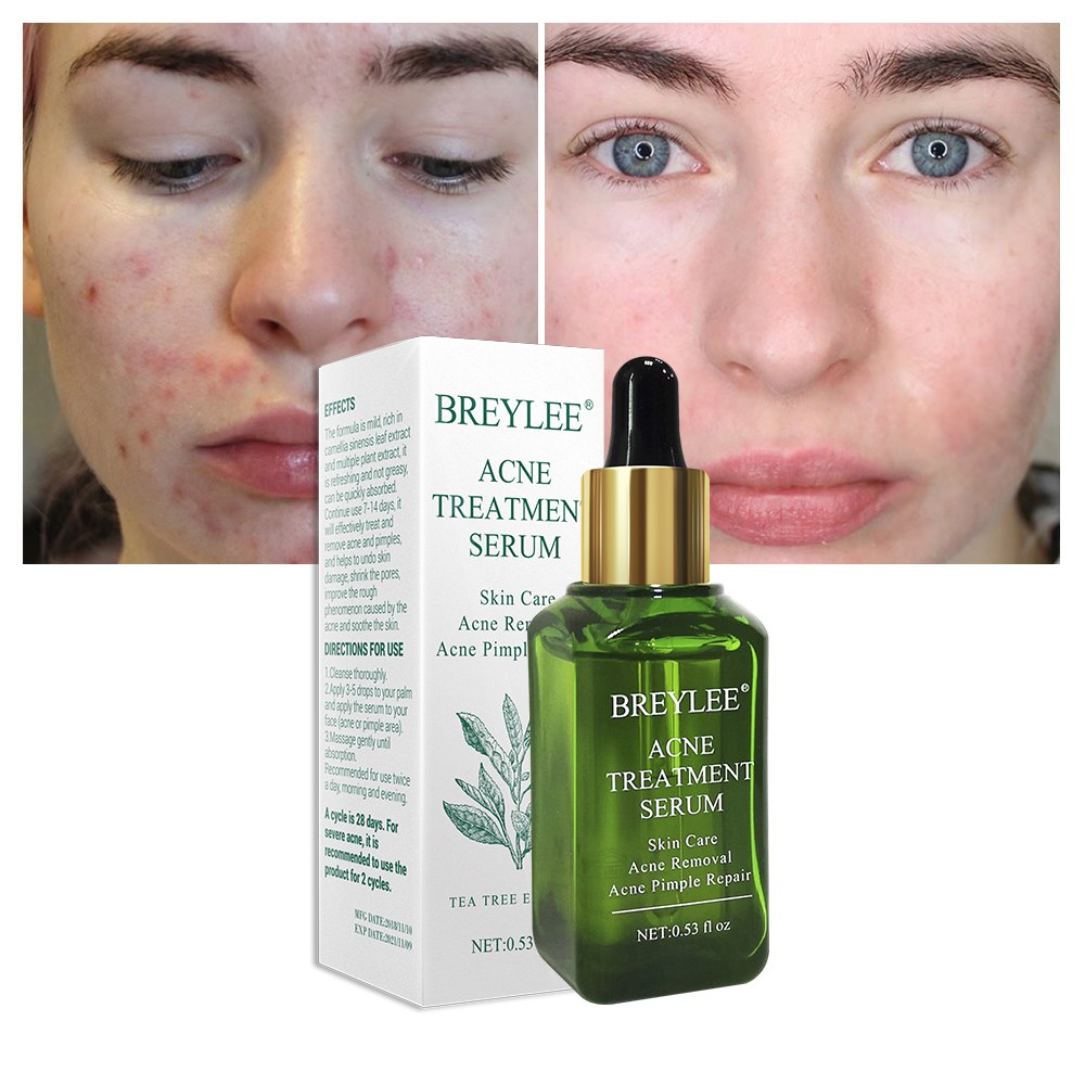 💧✨ BREYLEE Acne Treatment Serum
