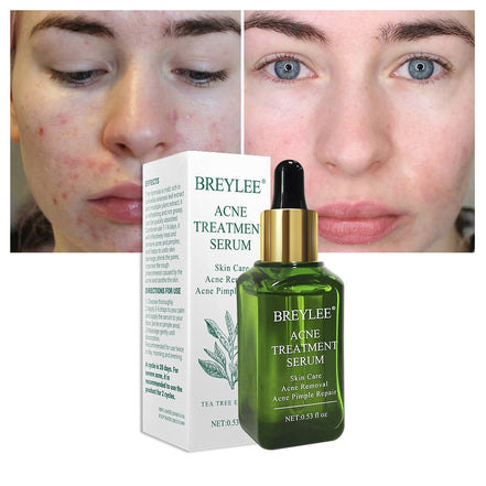 💧✨ BREYLEE Acne Treatment Serum